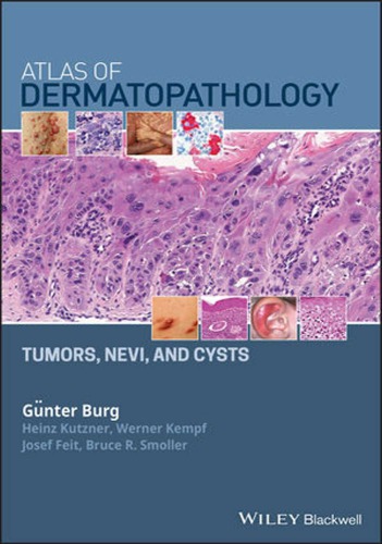 Atlas of Dermatopathology: Tumors, Nevi, and Cysts 1st Edition By Günter Burg – eBook PDF